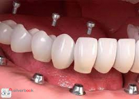 ایمپلنت دندان دیجیتال در ده دقیقه - دندانپزشکی